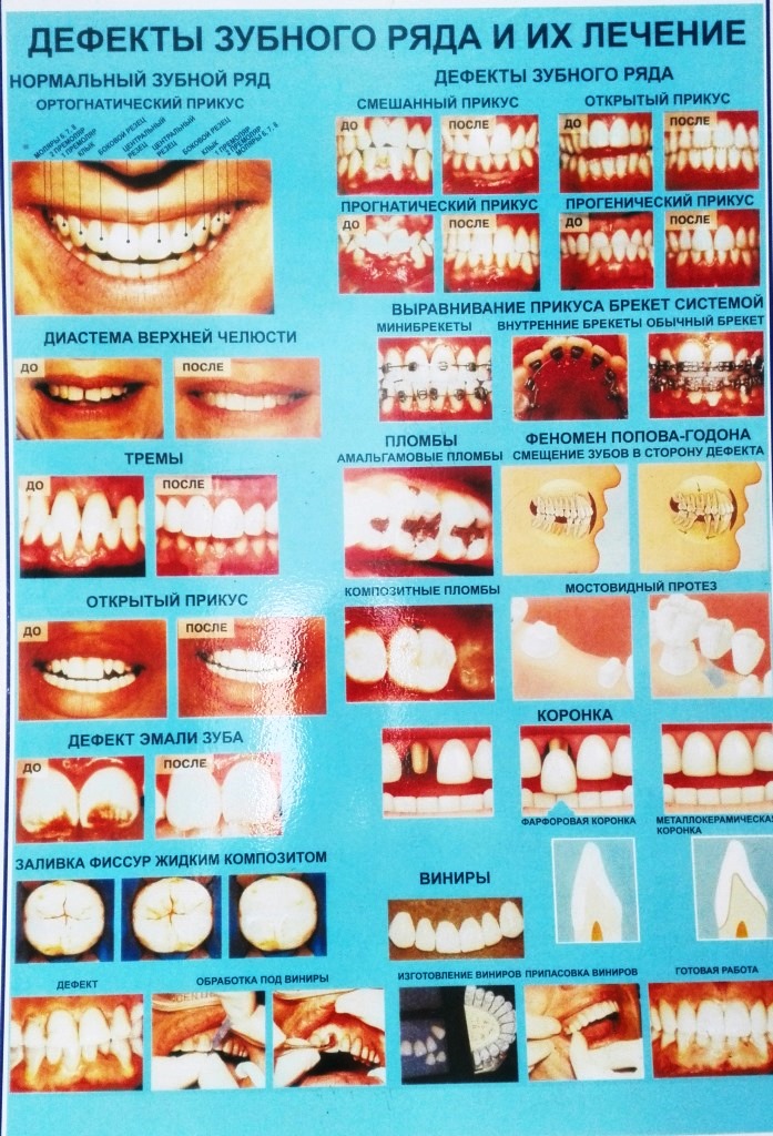Дефекты зубных рядов